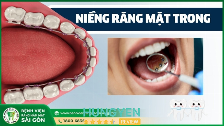 Niềng răng mặt trong