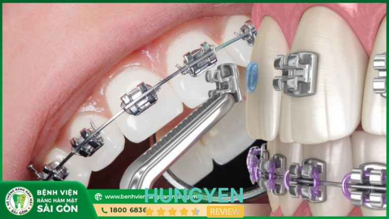 Niềng răng tại Bệnh Viện Răng Hàm Mặt Sài Gòn